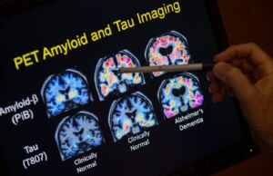 Alzheimer ve Parkinson Tamamen Ortadan Kaldırılabilir: Yeni Yöntemler Deneniyor Alzheimer ve parkinson